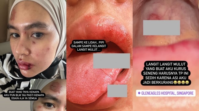 Kondisi wajah dan mulut Kartika Lee yang dipenuhi luka-luka. (Instagram/@kartikaputriworld)
